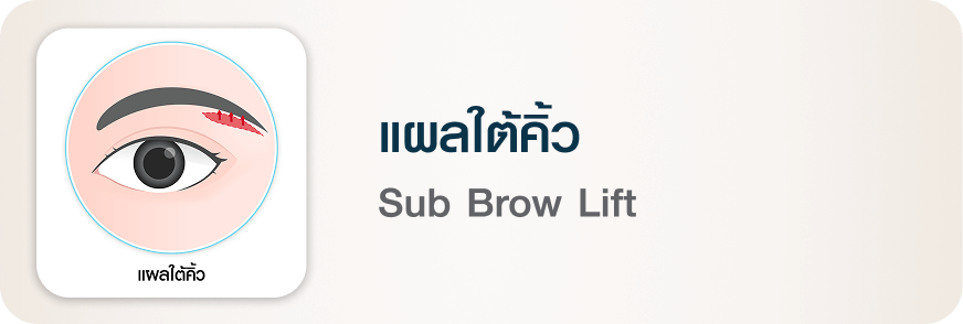 ศัลยกรรมตา แผลใต้คิ้ว Sub Brow Lift บีพราวด์ คลินิก