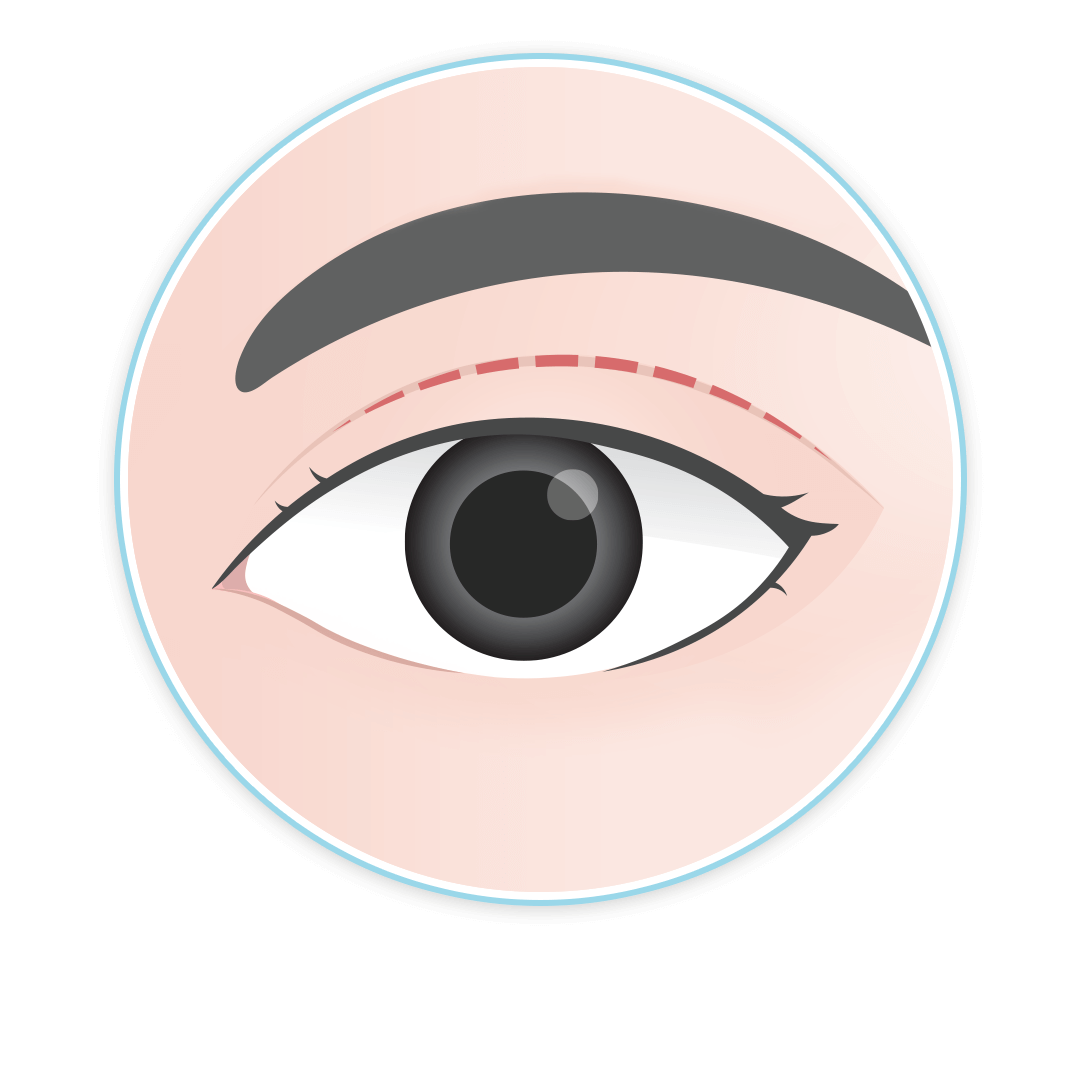 เทคนิคศัลยกรรมตา แก้ตาสองชั้น บีพราวด์คลินิก