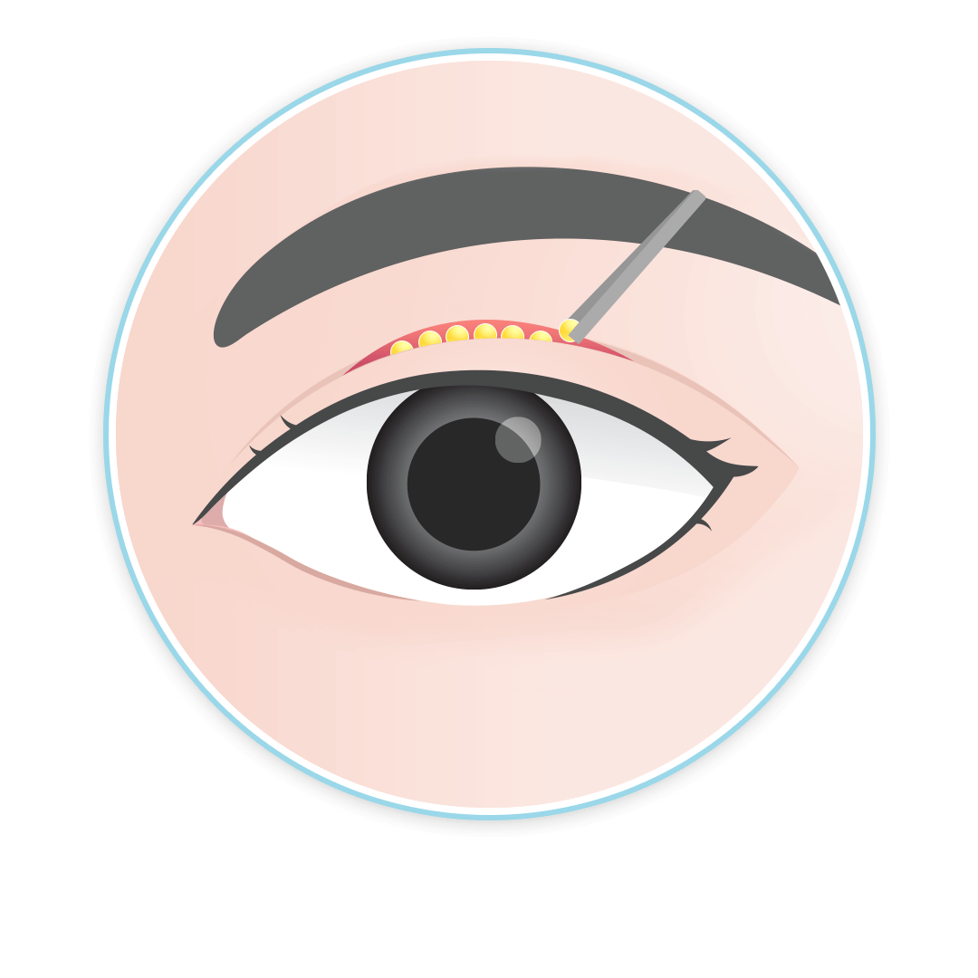 เทคนิคศัลยกรรมตา เติมไขมั้นเบ้าตาลึก บีพราวด์คลินิก