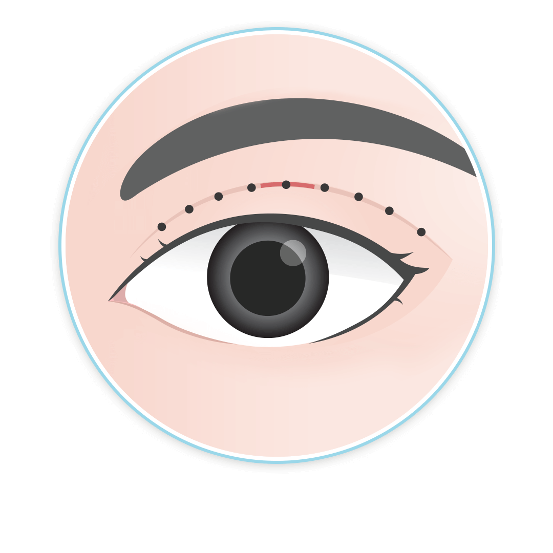 เทคนิคศัลยกรรมตา ตาสองชั้น บีพราวด์คลินิก