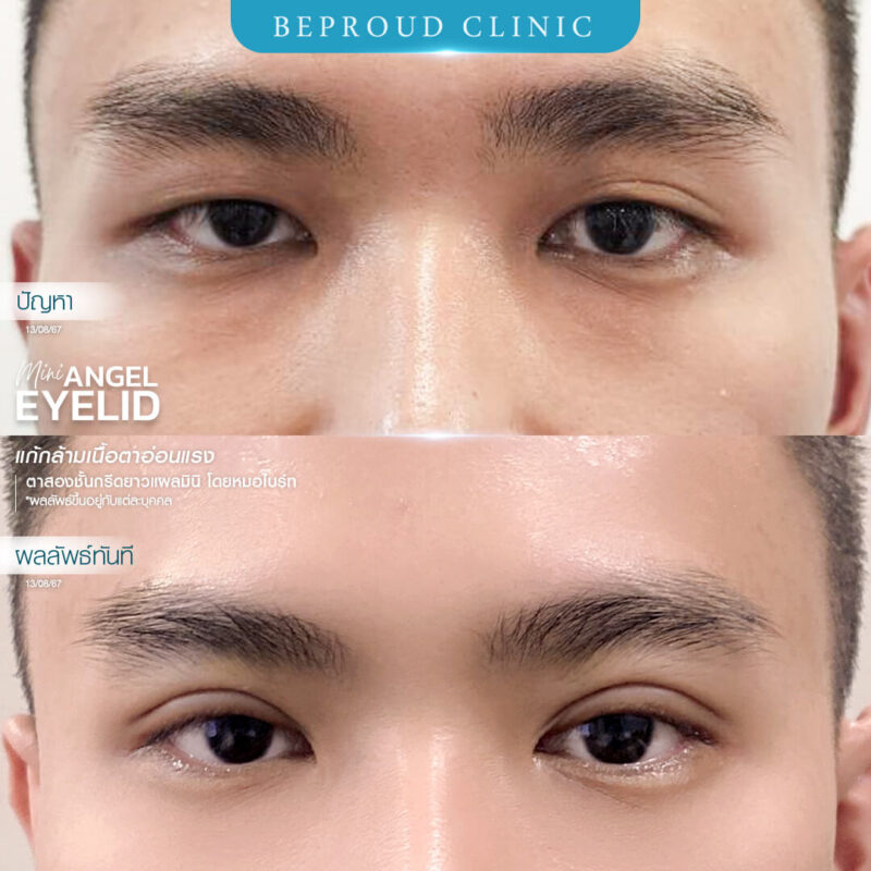 ภาพรีวิวเปรียบเทียบผลลัพธ์ ก่อนทำ-หลังทำศัลยกรรมแก้ตาสองชั้นผู้ชาย ของเคสตัวอย่าง เทคนิคกรีดตายาวแผลมินิ แก้กล้ามเนื้อตาอ่อนแรง โดยหมอไบร์ท บีพราวด์คลินิก