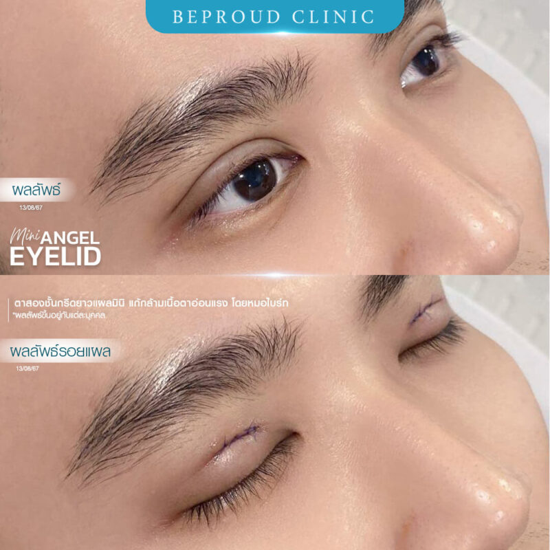ภาพรีวิวเปรียบเทียบผลลัพธ์ ก่อนทำ-หลังทำศัลยกรรมแก้ตาสองชั้นผู้ชาย ของเคสตัวอย่าง เทคนิคกรีดตายาวแผลมินิ แก้กล้ามเนื้อตาอ่อนแรง โดยหมอไบร์ท บีพราวด์คลินิก