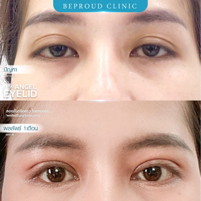 ภาพรีวิวเปรียบเทียบผลลัพธ์ ก่อนทำ-หลังทำศัลยกรรมตาสองชั้น ของเคสตัวอย่าง เทคนิคกรีดตายาว โดยหมอขิม บีพราวด์คลินิก