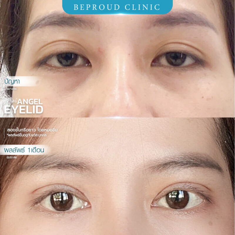 ภาพรีวิวเปรียบเทียบผลลัพธ์ ก่อนทำ-หลังทำศัลยกรรมตาสองชั้น ของเคสตัวอย่าง เทคนิคกรีดตายาว โดยหมอขิม บีพราวด์คลินิก