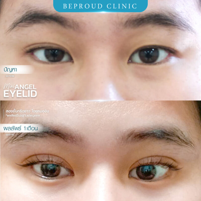ภาพรีวิวเปรียบเทียบผลลัพธ์ ก่อนทำ-หลังทำศัลยกรรมตาสองชั้น ของเคสตัวอย่าง เทคนิคกรีดตายาว โดยหมอขิม บีพราวด์คลินิก