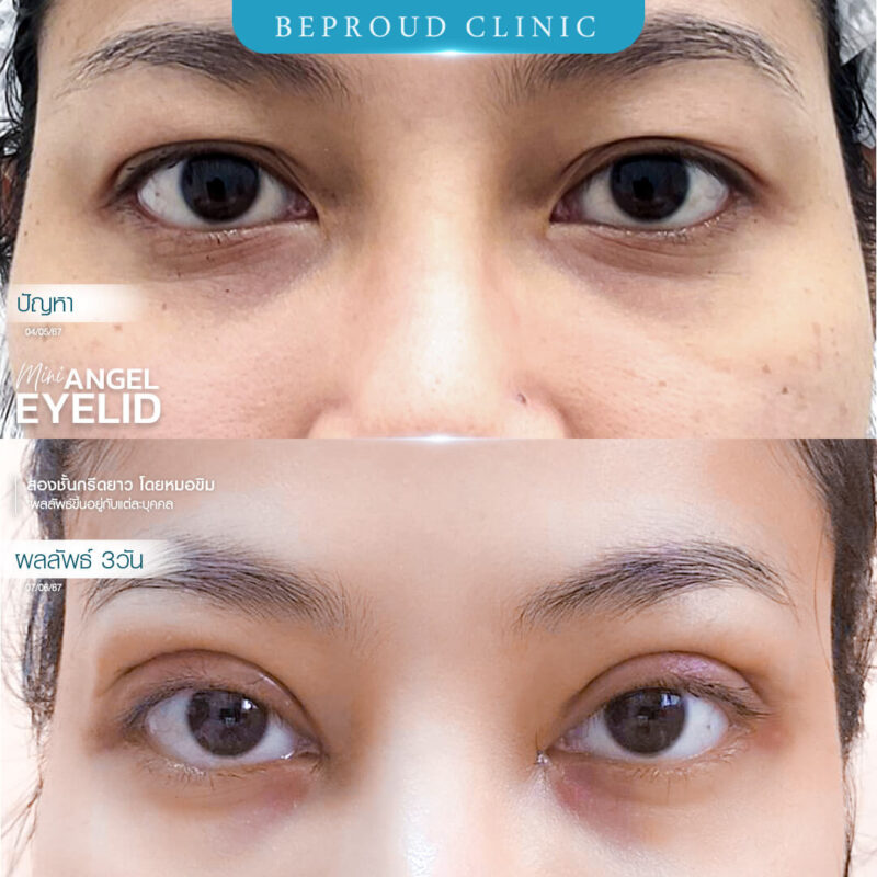 ภาพรีวิวเปรียบเทียบผลลัพธ์ ก่อนทำ-หลังทำศัลยกรรมตาสองชั้น ของเคสตัวอย่าง เทคนิคกรีดตายาว โดยหมอขิม บีพราวด์คลินิก