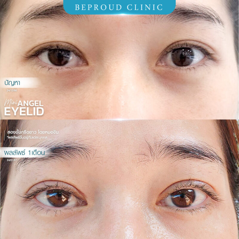 ภาพรีวิวเปรียบเทียบผลลัพธ์ ก่อนทำ-หลังทำศัลยกรรมตาสองชั้น ของเคสตัวอย่าง เทคนิคกรีดตายาว โดยหมอขิม บีพราวด์คลินิก