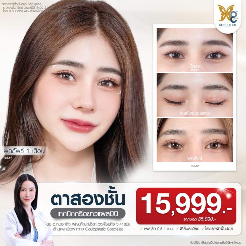 โปรโมชั่นศัลยกรรมตา พญ.กัญญ์ชิสา วงศ์ไชยกิจ อ.หมอหลิง จักษุแพทย์เฉพาะทางด้านจักษุตกแต่งและเสริมสร้าง (Oculoplastic Specialist) ประจำ Beproud Clinic