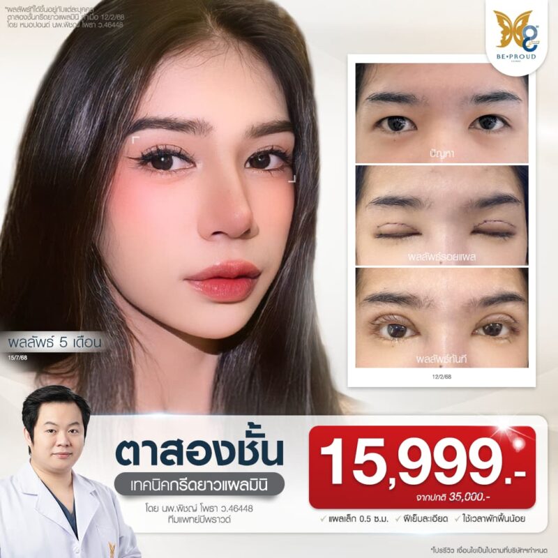 โปรโมชั่นศัลยกรรมตา หมอปอนด์ นพ.พิชญ์ โพธา แพทย์ผู้มีประสบการณ์ด้านการศัลยกรรมใบหน้า ตาสองชั้น เสริมจมูก เสริมคาง บีพราวด์คลินิก