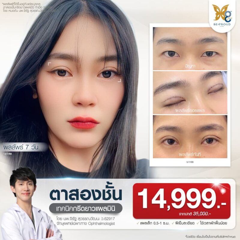 โปรโมชั่นศัลยกรรมตา นพ.จิรัฐ สุวรรณวัฒนะ จักษุแพทย์เฉพาะทาง ผู้เชี่ยวชาญศัลยกรรมตาสองชั้น แก้ปัญหารอบดวงตา ที่บีพราวด์คลินิก