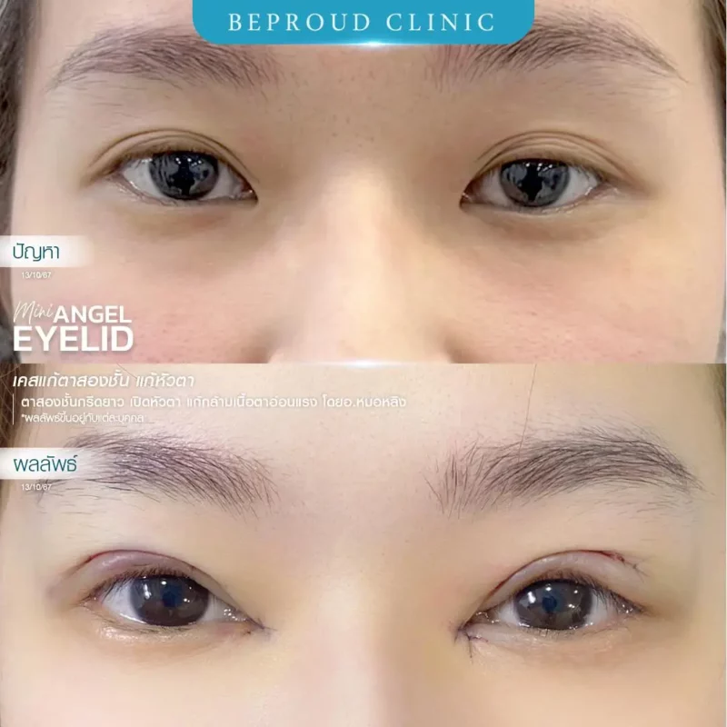 ภาพรีวิวเปรียบเทียบผลลัพธ์ ก่อนทำ-หลังทำศัลยกรรมแก้ตาสองชั้น ของเคสตัวอย่าง เทคนิคกรีดตายาว เปิดหัวตาและแก้กล้ามเนื้อตาอ่อนแรง โดยอ.หมอหลิง บีพราวด์คลินิก