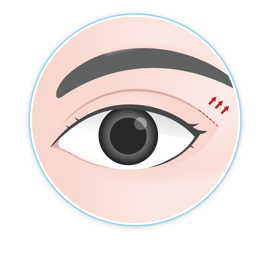 เทคนิคศัลยกรรมตา เย็บยกหางตา Angel Fix บีพราวด์คลินิก