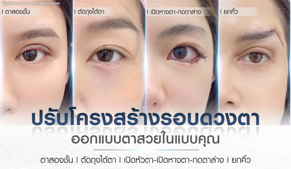บริการศัลยกรรมตา Beproud Clinic ปรับโครงสร้างรอบดวงตา และ ออกแบบตาสวยในแบบคุณ