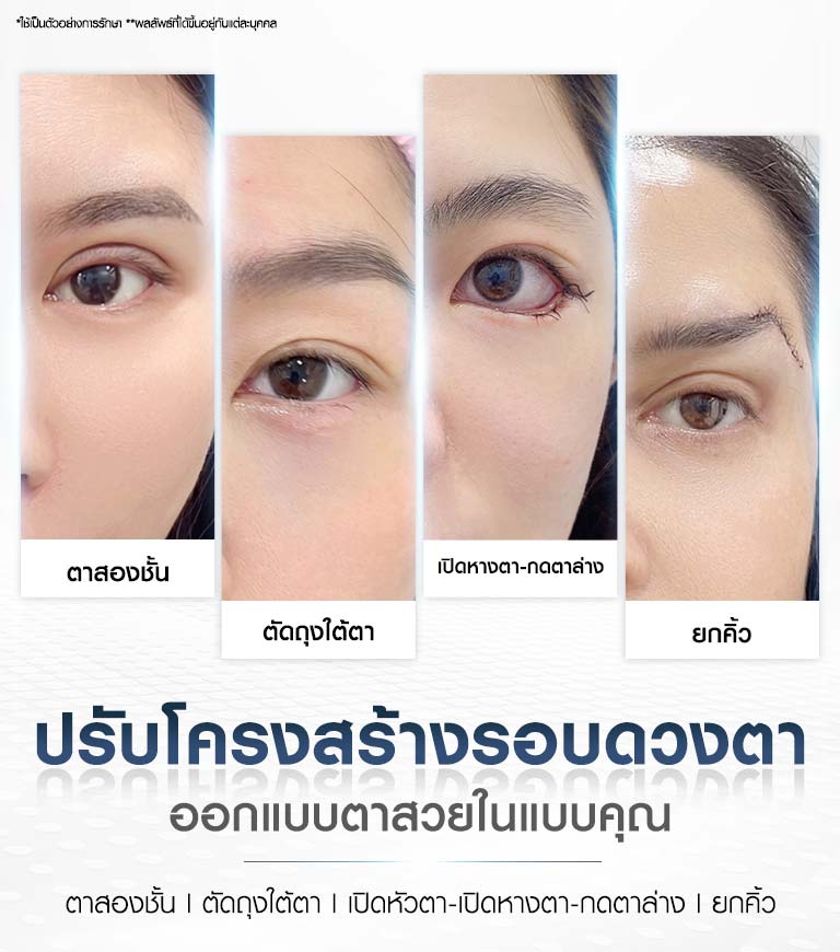 บริการศัลยกรรมตา Beproud Clinic ปรับโครงสร้างรอบดวงตา และ ออกแบบตาสวยในแบบคุณ