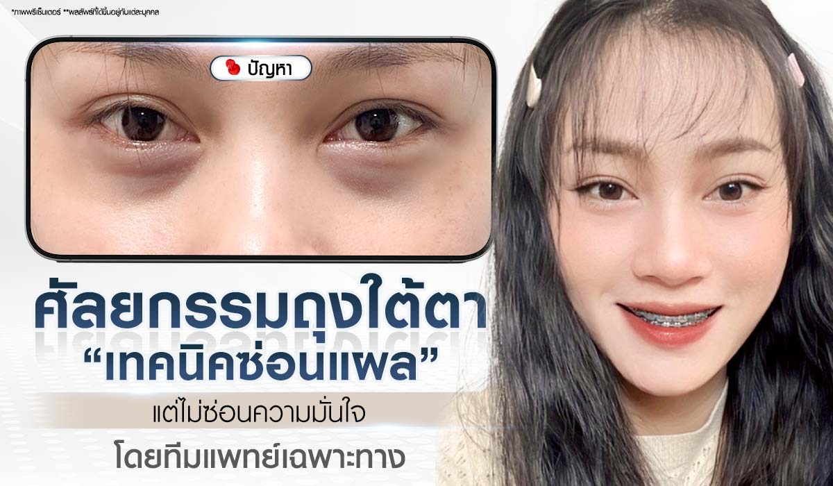 ศัลยกรรมถุงใต้ตา เทคนิคซ่อนแผล Beproud Clinic แก้ปัญหาถุงใต้ตาที่มองเห็นชัดเจน ให้กลับมามีความมั่นใจ