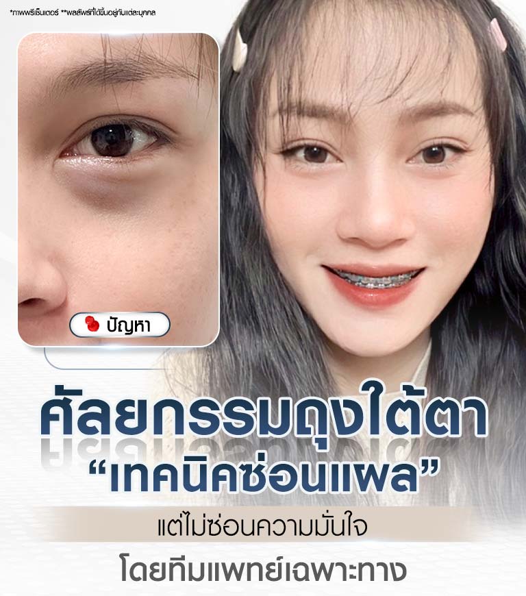 ศัลยกรรมถุงใต้ตา เทคนิคซ่อนแผล Beproud Clinic แก้ปัญหาถุงใต้ตาที่มองเห็นชัดเจน ให้กลับมามีความมั่นใจ