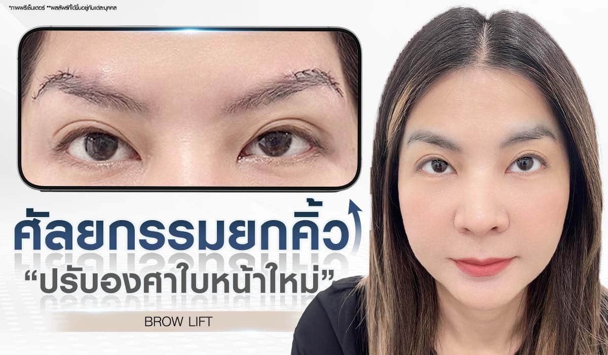 ศัลยกรรมยกคิ้ว BROW LIFT Beproud Clinic ปรับองศาใบหน้าใหม่ แก้ปัญหาคิ้วตก หางตาตก ที่ทำให้ใบหน้าดูเศร้าหมอง