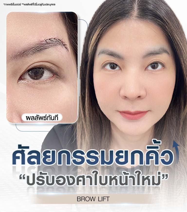 ศัลยกรรมยกคิ้ว BROW LIFT Beproud Clinic ปรับองศาใบหน้าใหม่ แก้ปัญหาคิ้วตก หางตาตก ที่ทำให้ใบหน้าดูเศร้าหมอง