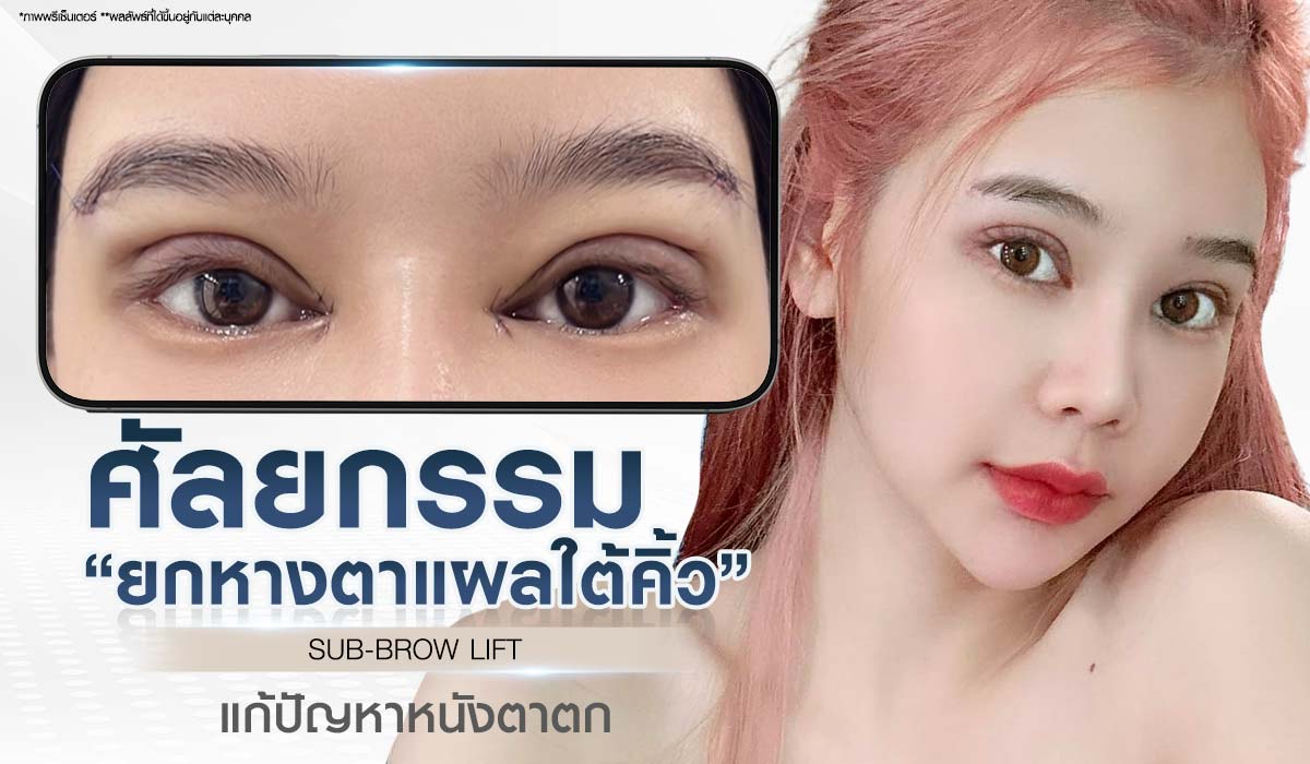 ศัลยกรรมยกหางตาแผลใต้คิ้ว SUB BROW LIFT แก้ไขปัญหาหนังตาตก Beproud Clinic