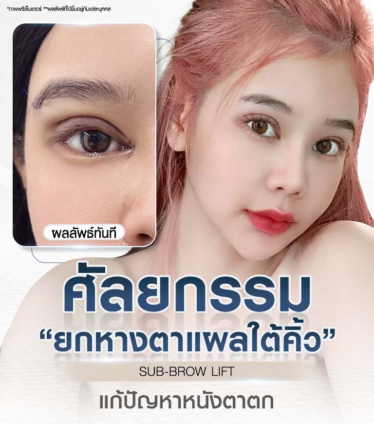 ศัลยกรรมยกหางตาแผลใต้คิ้ว SUB BROW LIFT แก้ไขปัญหาหนังตาตก Beproud Clinic