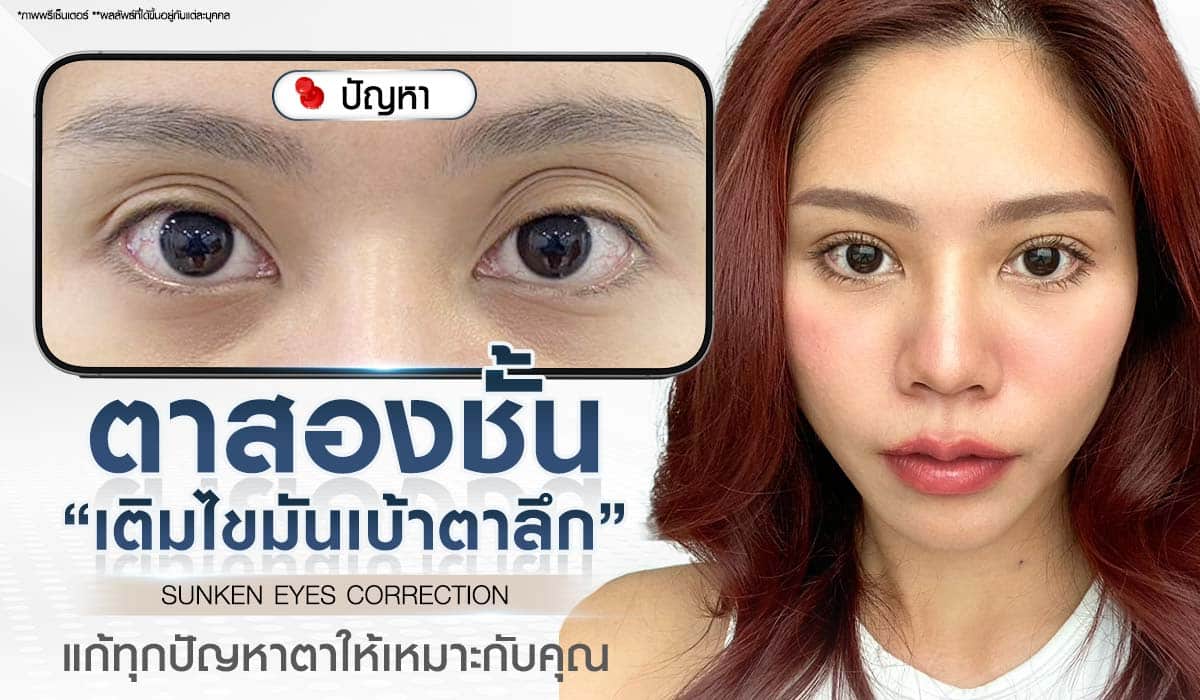 ศัลยกรรมตาสองชั้น เติมไขมันเข้าเบ้าตาลึก SUNKEN EYES CORRECTION แก้ปัญหาดวงตาที่มีปัญหาเบ้าตาลึกให้เหมาะกับคุณ Beproud Clinic
