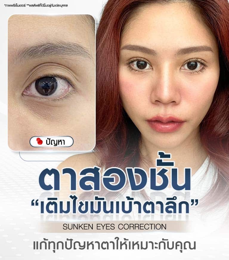 ศัลยกรรมตาสองชั้น เติมไขมันเข้าเบ้าตาลึก SUNKEN EYES CORRECTION แก้ปัญหาดวงตาที่มีปัญหาเบ้าตาลึกให้เหมาะกับคุณ Beproud Clinic