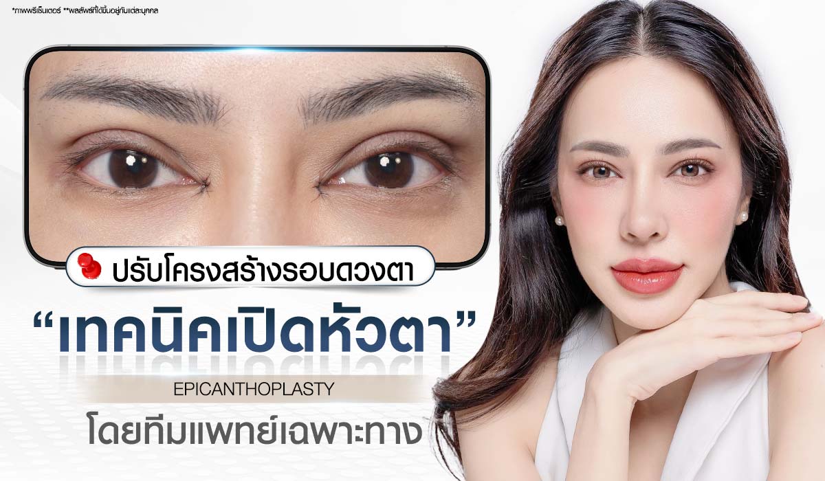 ศัลยกรรมเปิดหัวตา EPICANTHOPLASTY แสดงภาพใบหน้าลูกค้าที่ดวงตาดูยาวและมีชั้นตาที่หัวตาชัดเจนขึ้น เน้นการปรับโครงสร้างรอบดวงตาโดยทีมแพทย์เฉพาะทาง Beproud Clinic