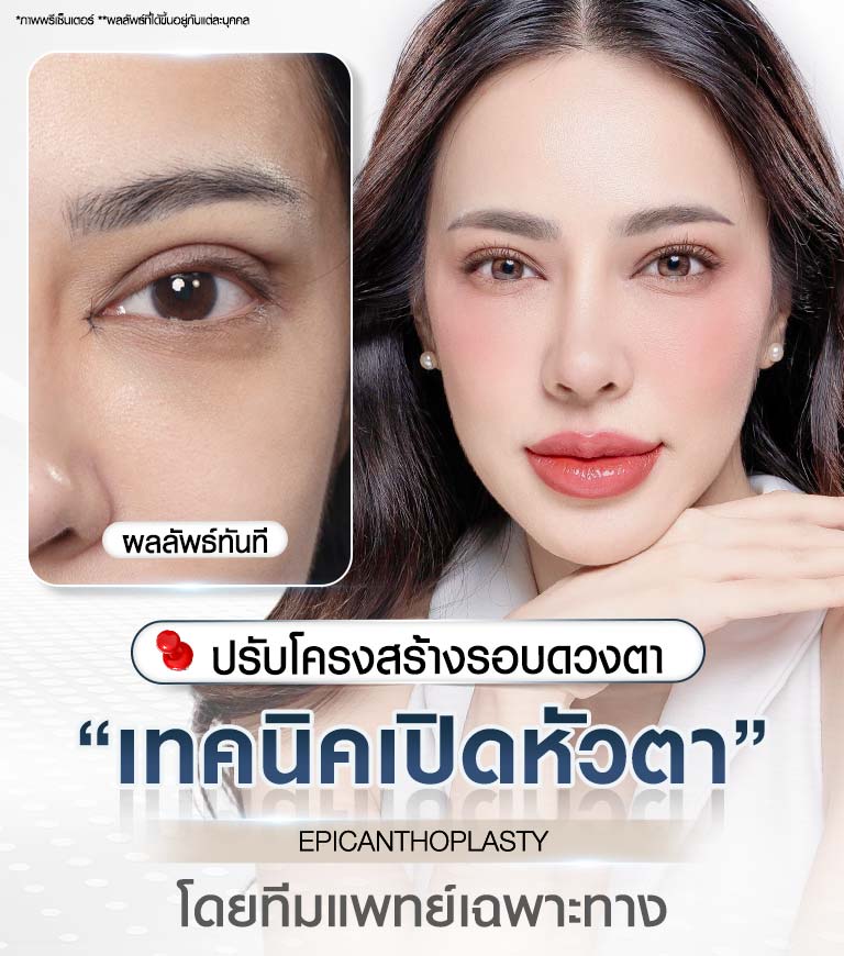 ศัลยกรรมเปิดหัวตา EPICANTHOPLASTY แสดงภาพใบหน้าลูกค้าที่ดวงตาดูยาวและมีชั้นตาที่หัวตาชัดเจนขึ้น เน้นการปรับโครงสร้างรอบดวงตาโดยทีมแพทย์เฉพาะทาง Beproud Clinic