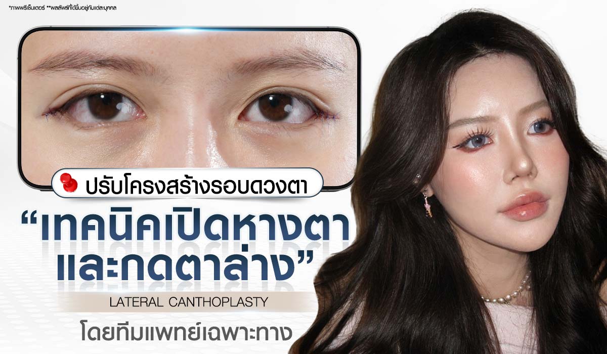 ศัลยกรรมเปิดหางตาและกดตาล่าง LATERAL CANTHOPLASTY ปรับโครงสร้างรอบดวงตา โดยทีมแพทย์เฉพาะทาง Beproud Clinic