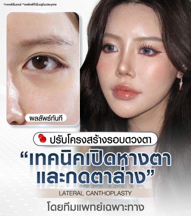 ศัลยกรรมเปิดหางตาและกดตาล่าง LATERAL CANTHOPLASTY ปรับโครงสร้างรอบดวงตา โดยทีมแพทย์เฉพาะทาง Beproud Clinic