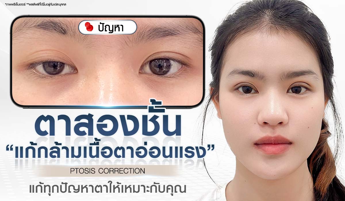 ศัลยกรรมตาสองชั้น แก้กล้ามเนื้อตาอ่อนแรง PTOSIS CORRECTION แก้ทุกปัญหาตาให้เหมาะกับคุณ Beproud Clinic