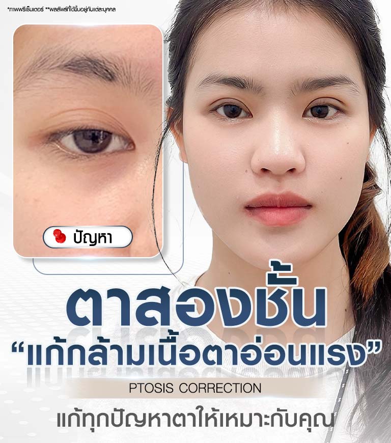 ศัลยกรรมตาสองชั้น แก้กล้ามเนื้อตาอ่อนแรง PTOSIS CORRECTION แก้ทุกปัญหาตาให้เหมาะกับคุณ Beproud Clinic