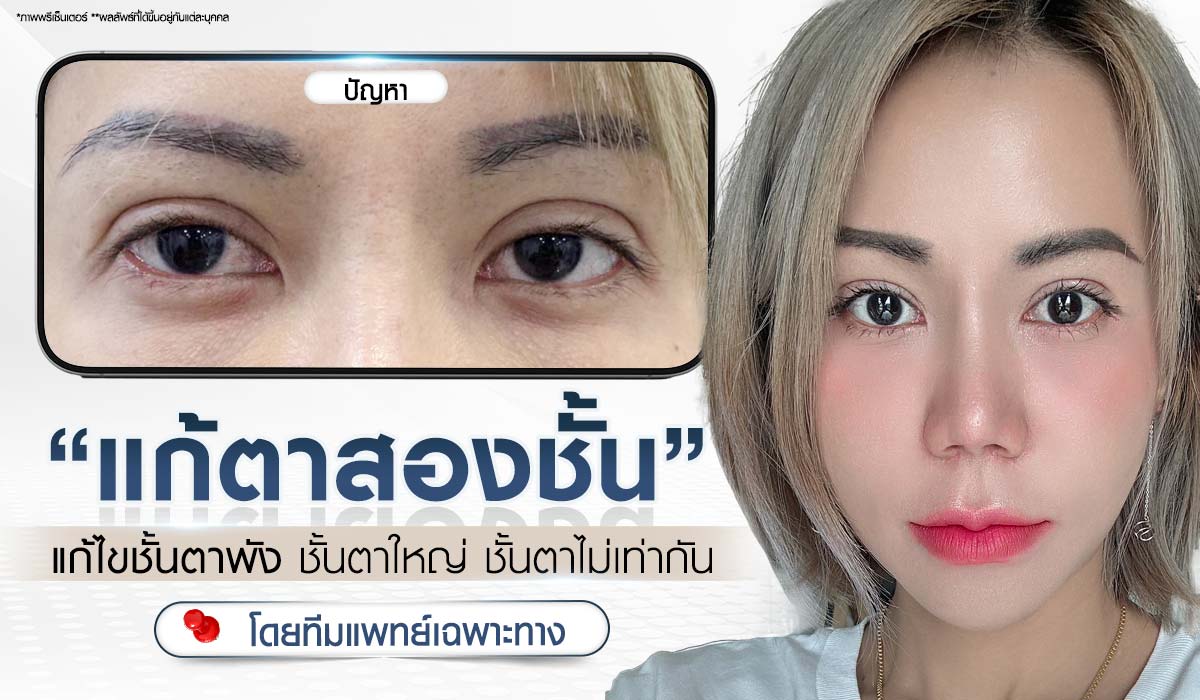 บริการ แก้ตาสองชั้น แก้ปัญหาชั้นพัง ชั้นตาตก ชั้นตาไม่เท่ากัน โดยทีมแพทย์เฉพาะทาง Beproud Clinic