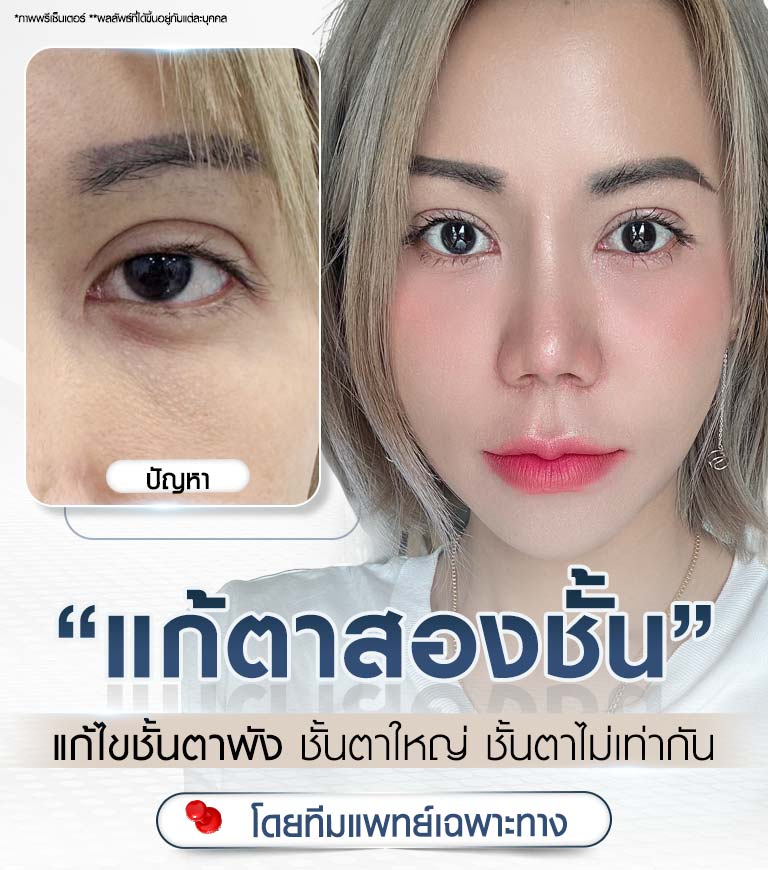 บริการ แก้ตาสองชั้น แก้ปัญหาชั้นพัง ชั้นตาตก ชั้นตาไม่เท่ากัน โดยทีมแพทย์เฉพาะทาง Beproud Clinic