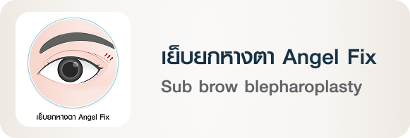 เทคนิคศัลยกรรม เย็บยกหางตา Angel Fix Sub brow blepharoplasty Angel Fix Beproud Clinic