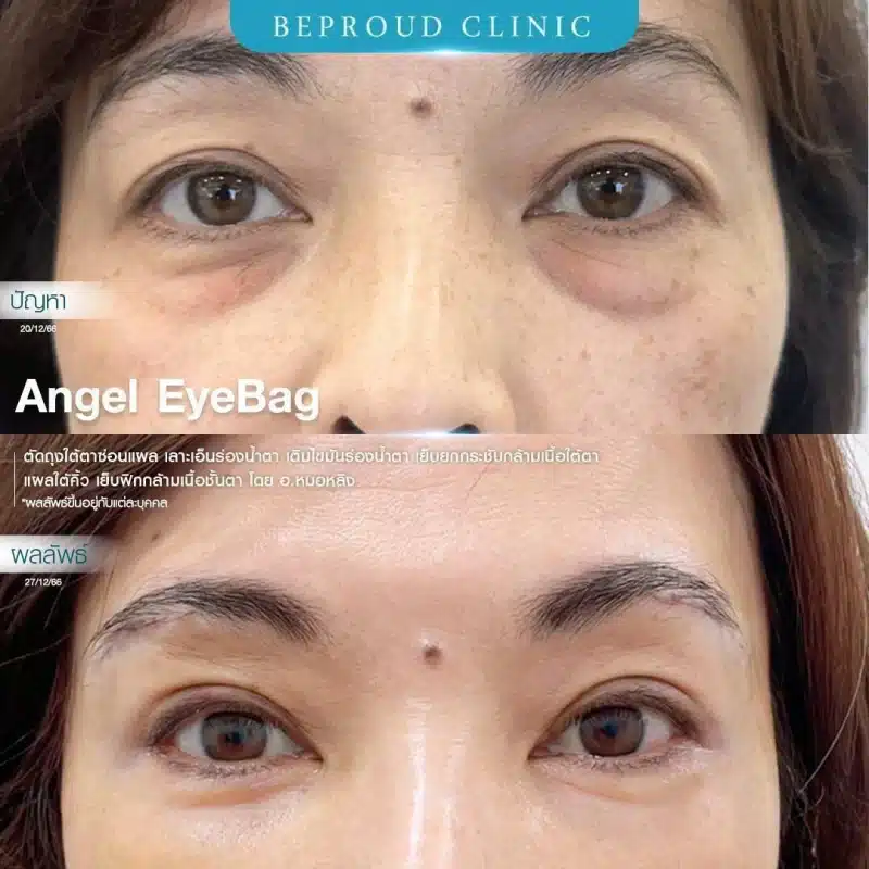 ภาพเปรียบเทียบ BEFORE AFTER ศัลยกรรม Angel EyeBag "ปัญหา" ถุงใต้ตาและร่องน้ำตาลึกในผู้หญิงวัยกลางคน ผลลัพธ์ ใต้ตาเรียบเนียนขึ้นหลังทำ