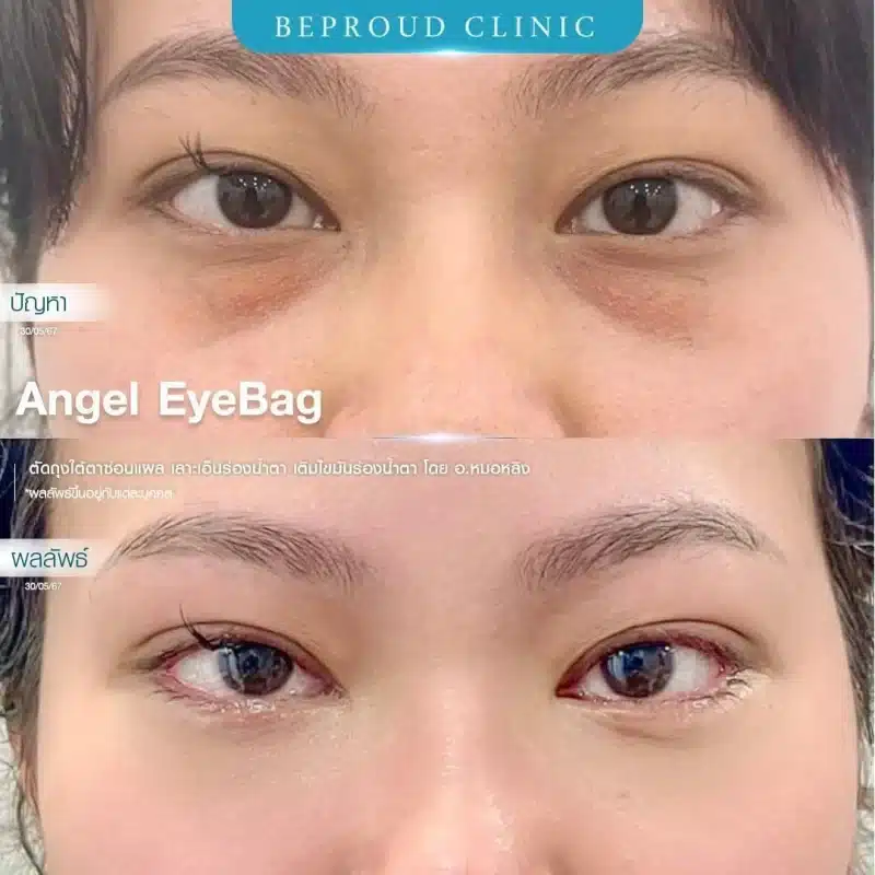 ภาพเปรียบเทียบ BEFORE AFTER ศัลยกรรม Angel EyeBag "ปัญหา" ถุงใต้ตาที่ปูดบวมชัดเจนและร่องน้ำตาลึก "ผลลัพธ์" ใต้ตาเรียบเนียนขึ้นหลังทำ
