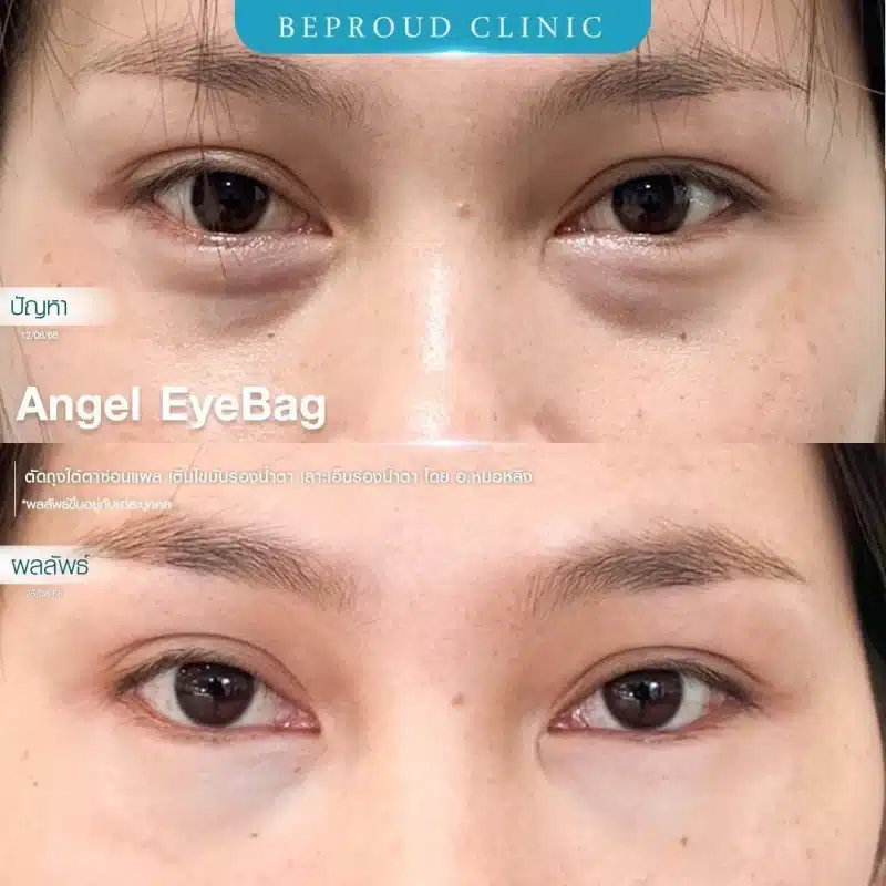 ภาพเปรียบเทียบ BEFORE AFTER ศัลยกรรม Angel EyeBag "ปัญหา" ถุงใต้ตาที่ปูดบวมชัดเจนและร่องน้ำตาลึก "ผลลัพธ์" ใต้ตาเรียบเนียนขึ้นหลังทำ