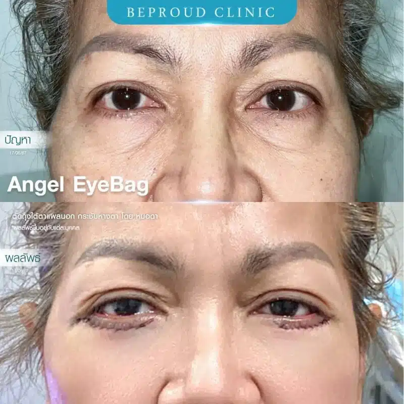 ภาพเปรียบเทียบ BEFORE AFTER ศัลยกรรม Angel EyeBag โดยหมอดา "ปัญหา"ถุงใต้ตาหย่อนคล้อย "ผลลัพธ์" หลังทำตาสองชั้นกรีดยาว จัดเรียงไขมัน ตัดถุงใต้ตาแผลนอก