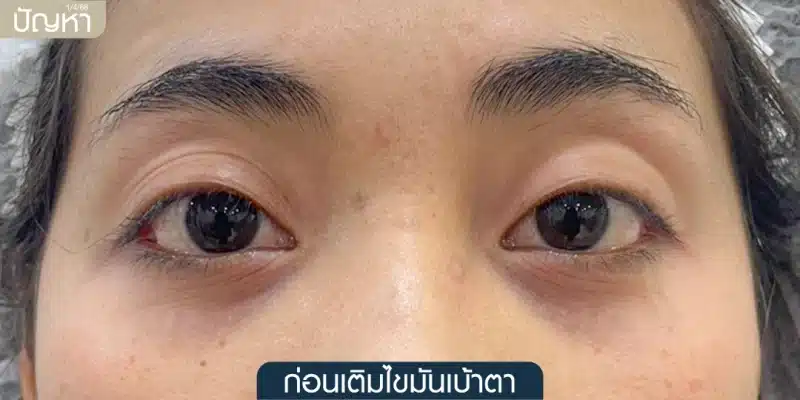 ภาพถ่ายดวงตาผู้หญิง แสดงปัญหาเบ้าตาลึก (Sunken Eyes) อย่างชัดเจนบริเวณเปลือกตาบน ก่อนการรักษาด้วยการเติมไขมันเบ้าตา