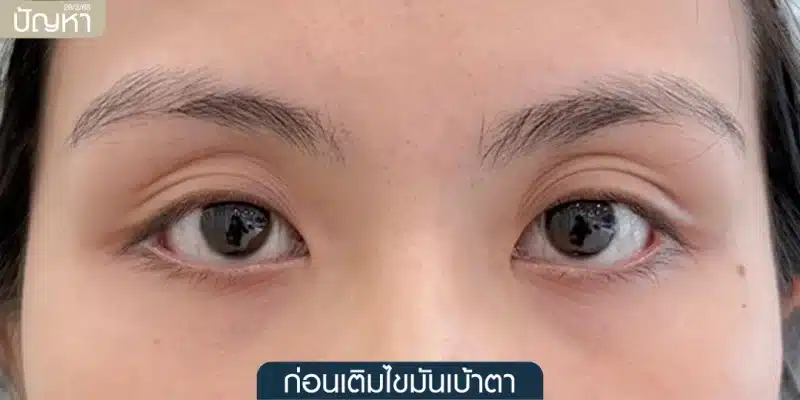 ภาพเคสตัวอย่างแสดงปัญหาเบ้าตาลึก (Sunken Eyes) และอาการตาลืมไม่เต็มที่ (ตาปรือ) ซึ่งเป็นภาวะกล้ามเนื้อตาอ่อนแรง ก่อนการทำศัลยกรรม