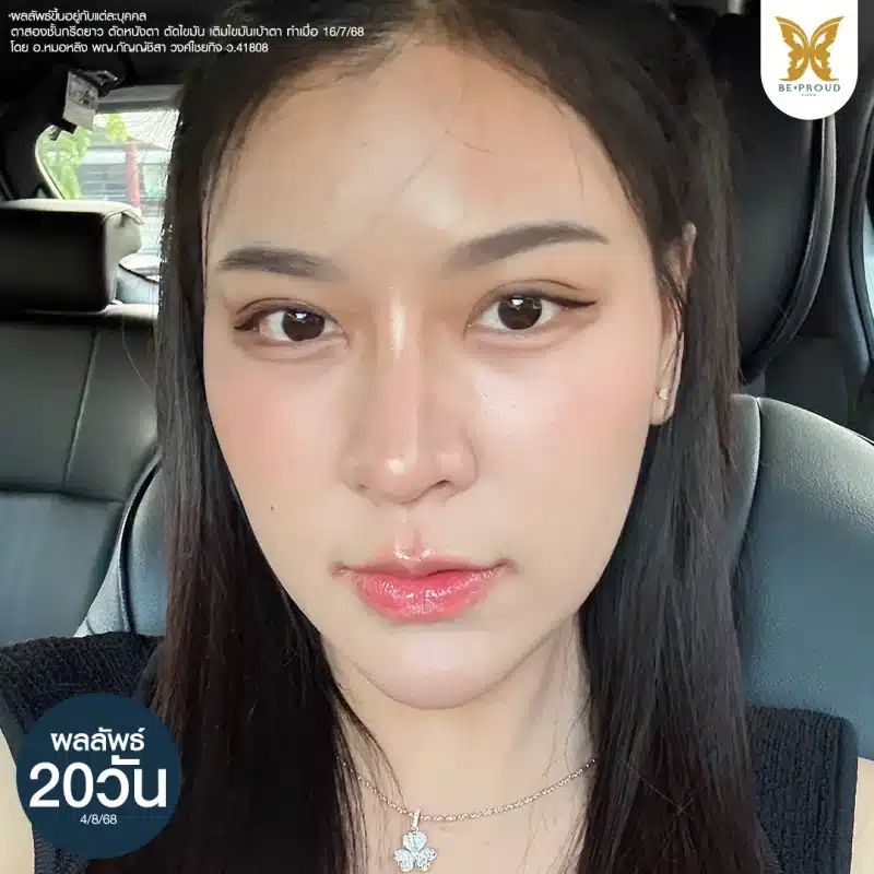 ภาพเปรียบเทียบผลลัพธ์ทันทีหลังทำตาสองชั้นและเติมไขมันเบ้าตา