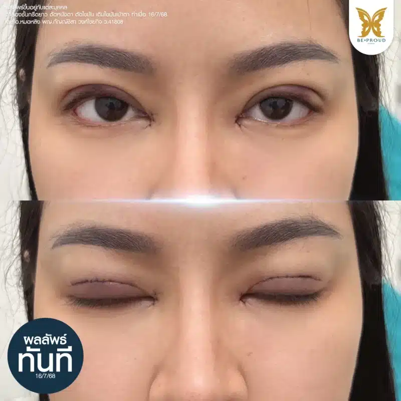 ภาพเปรียบเทียบหลังการทำตาสองชั้นและเติมไขมันเบ้าตา