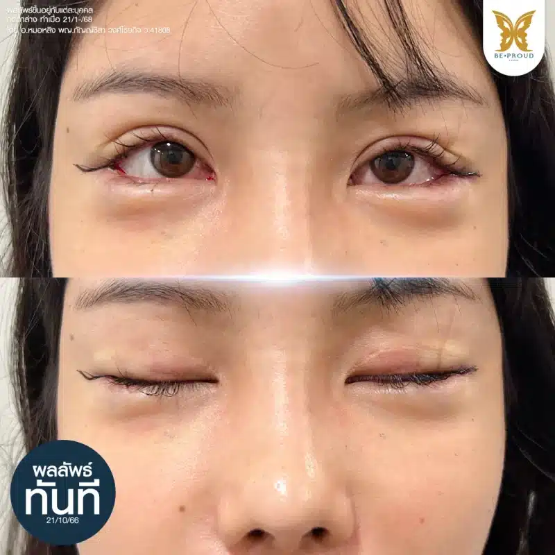 ภาพผลลัพธ์ทันทีหลังการทำศัลยกรรมกดตาล่าง รอยเย็บที่หางตาและขอบตาล่าง แสดงถึงการขยายดวงตาให้ดูกลมโตขึ้น