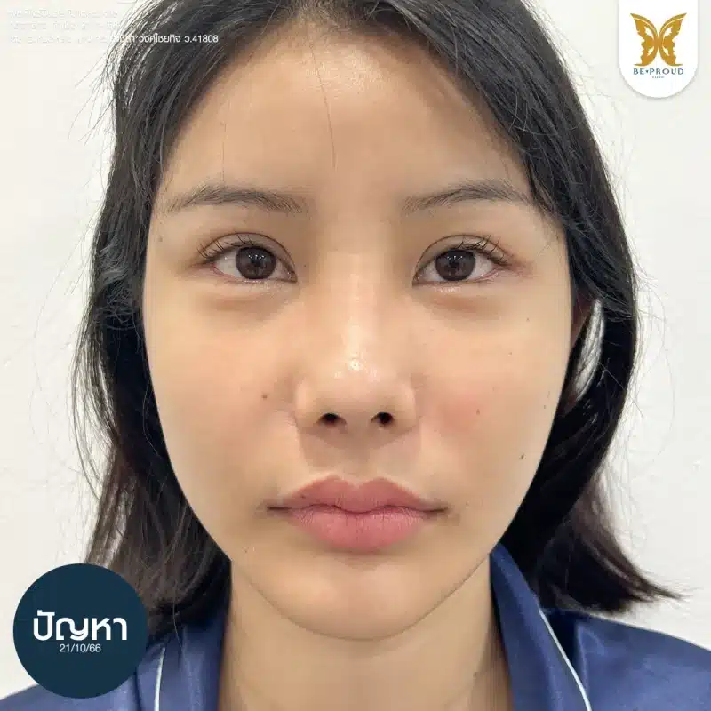 รูปภาพ Before ก่อนทำ ศัลยกรรมกดตาล่าง ระบุปัญหาและวันที่ตรวจประเมิน