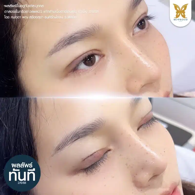 ภาพถ่ายเปรียบเทียบผลลัพธ์ทันทีหลังการผ่าตัดแก้ไขกล้ามเนื้อตาอ่อนแรงและการทำตาสองชั้น แสดงให้เห็นเปลือกตาที่เปิดได้มากขึ้นและชั้นตาที่ชัดเจน
