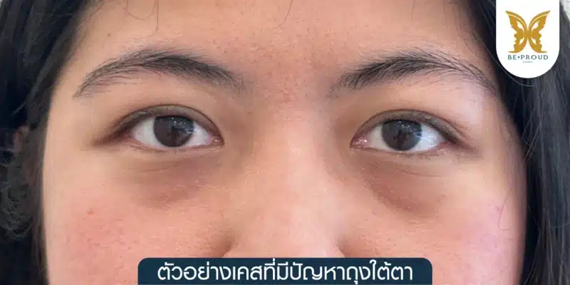 ภาพถ่ายเคสตัวอย่างแสดงลักษณะใต้ตาที่มีถุงไขมันปูดนูนและร่องน้ำตาชัดเจน สื่อถึงปัญหาถุงใต้ตา