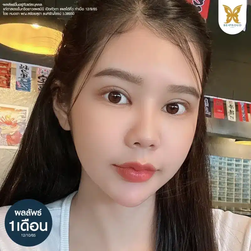 ภาพถ่ายคุณฟ้า แสดงผลลัพธ์หลังทำตาสองชั้นกรีดยาวแผลมินิและเปิดหัวตา 20 วัน ใบหน้าดูสดใส ดวงตากลมโตและเบ้าตาอิ่มเต็ม