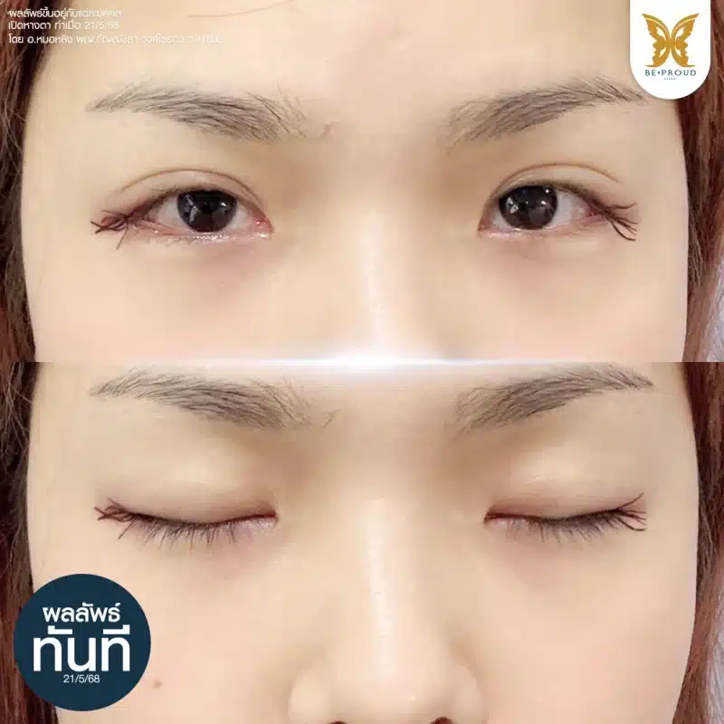 รูปภาพแสดงผลลัพธ์ทันทีหลังการทำศัลยกรรมเปิดหางตาฃเพื่อขยายดวงตาให้ดูเรียวยาวและกลมโตขึ้น