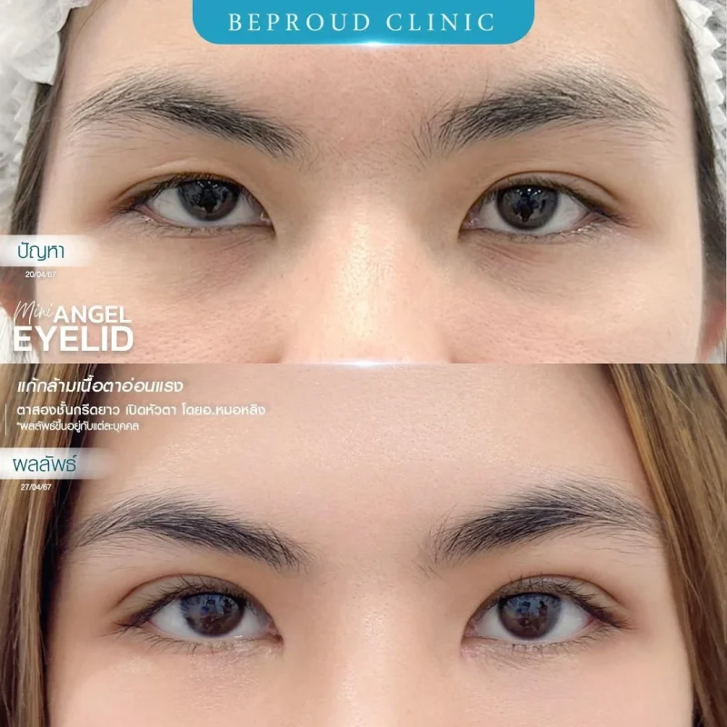 ภาพรีวิวเปรียบเทียบผลลัพธ์ ก่อนทำ-หลังทำศัลยกรรมตาสองชั้น ของเคสตัวอย่าง เทคนิคกรีดตายาว แก้กล้ามเนื้อตาอ่อนแรง เปิดหัวตา โดยอ.หมอหลิง บีพราวด์คลินิก